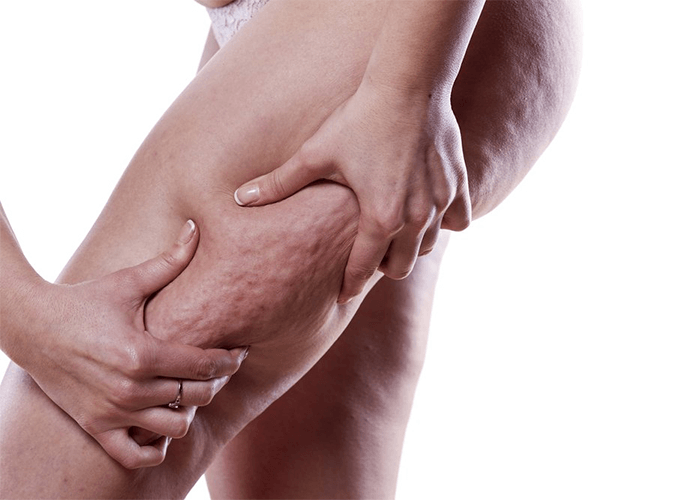 cellulite is